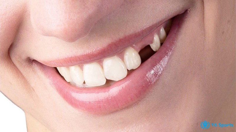 Mơ rụng răng có ý nghĩa đặc biệt
